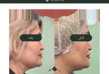 قیمت عمل غبغب و بهترین روش‌های رفع آن در یک جلسه