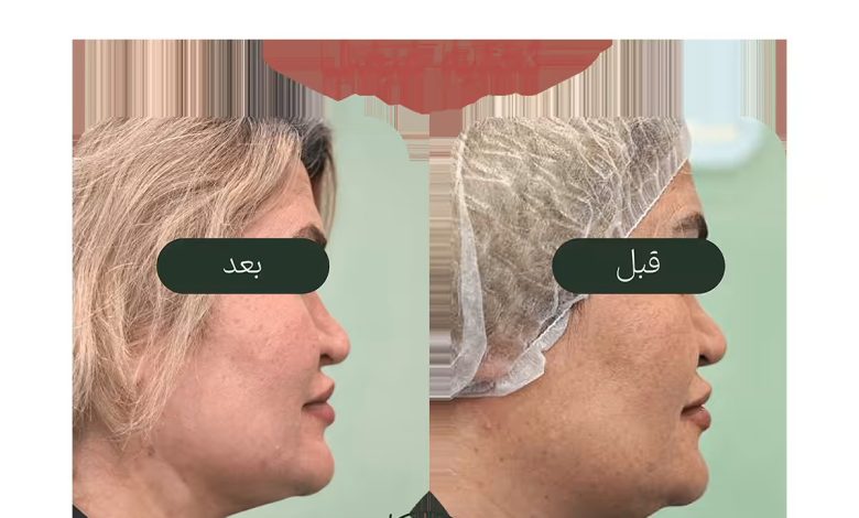قیمت عمل غبغب و بهترین روشهای رفع آن در یک جلسه