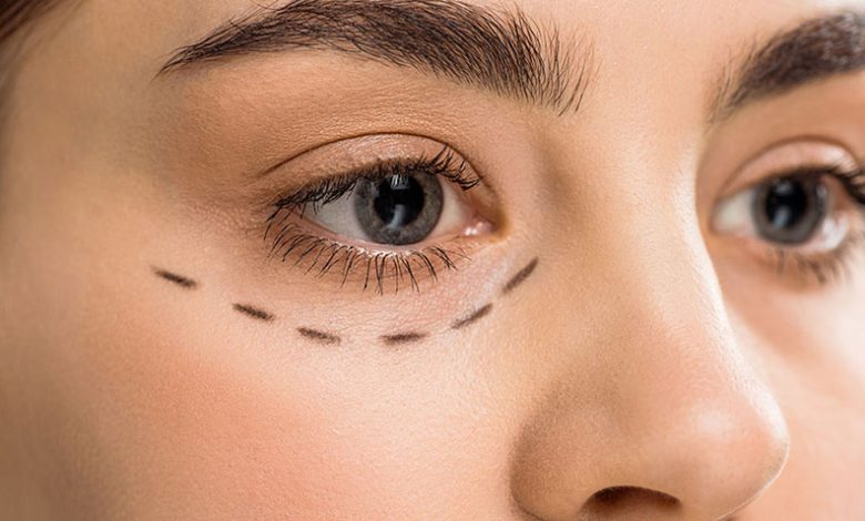 مقایسه بلفاروپلاستی پلک بالا و پایین؛ کدام گزینه بهتری است؟